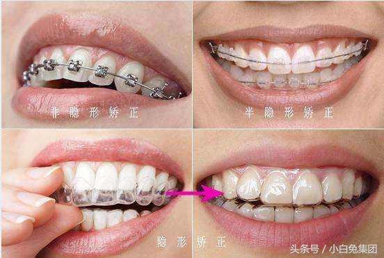 正畸最新技术，引领牙齿矫正的新时代
